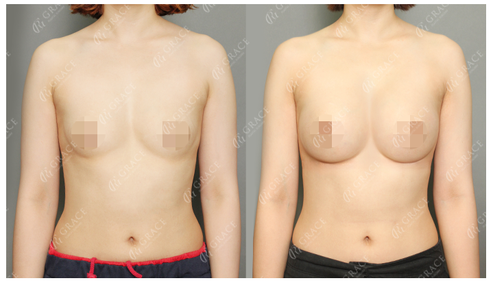 How Should You Choose a Good Breast Augmentation Clinic? image 1