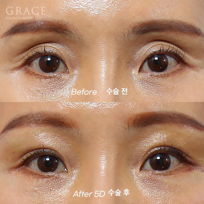 How Long Can Sunken Upper Eyelids Last Without Side Effects After Fat Grafting? image 1