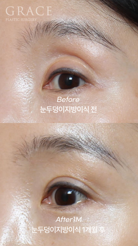 연예인도 고민한다는 아이홀 필러 부작용? 눈두덩이 지방이식으로 자연스럽게 관련 이미지 2
