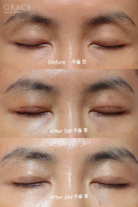 눈꺼풀 지방이식+눈매교정  40대 (눈 감았을 때 눈두덩이 흉터&middot;부작용 체크) 관련 이미지 2