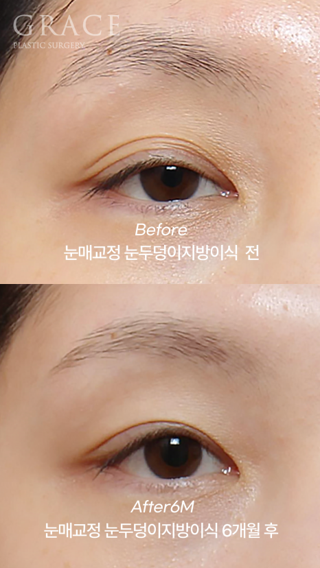 30대 눈꺼풀 지방이식 재꺼짐? 부작용? 6개월 후 관련 이미지 6