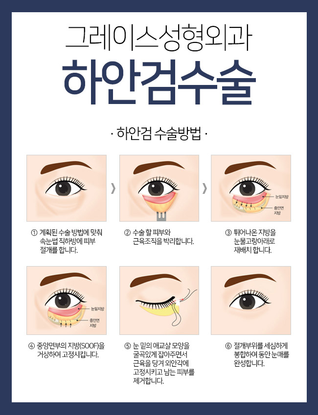 부모님 효도선물로 눈 밑 처짐을 해결해주는 하안검수술이 인기! 관련 이미지 3