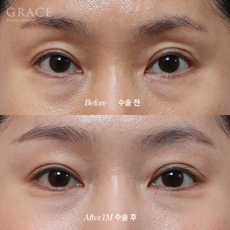 Why Choose Upper Eyelid Fat Grafting Instead of Eye-Hollow Filler? image 2