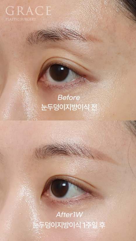 눈꺼풀 지방이식 잘하는 병원 그레이스성형외과 관련 이미지 2