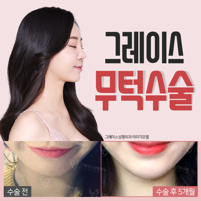 A Chin Augmentation Implant for a Refined Face Line image 4
