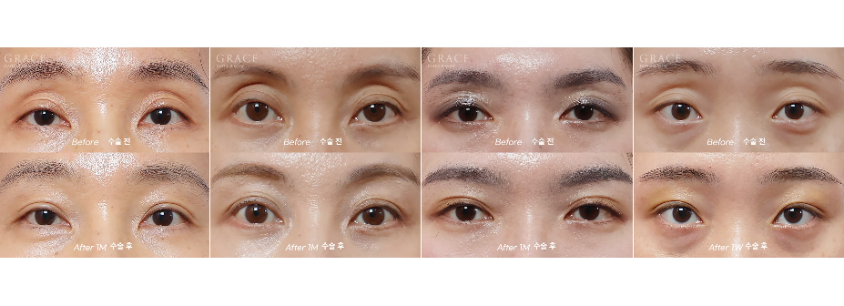 No to Frozen Fat That’s Completely Frozen! Eyelid Fat Grafting with Only Fresh Autologous Fat image 11