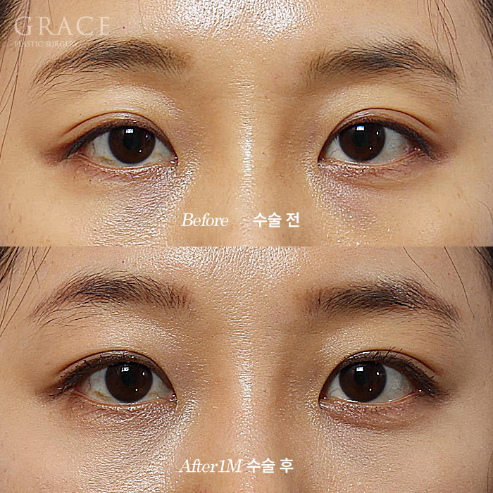 Why It’s Not Always Better Just Because Lower Eyelid Fat Grafting Is Cheap image 4