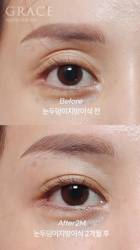 Eyebrow Fat Grafting &middot; Eyelid Fat Grafting &middot; Sunken Eyes Surgery Cost Information (As of June 2025) image 10