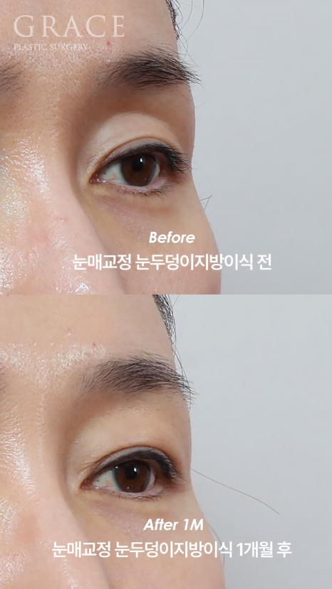 What Is the Problem with the Side Effects of a Lumpy Eyelid Fat Graft? image 5