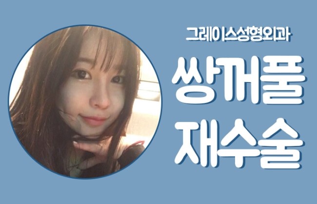성공적인 쌍꺼풀재수술, 그레이스성형외과 관련 이미지 2