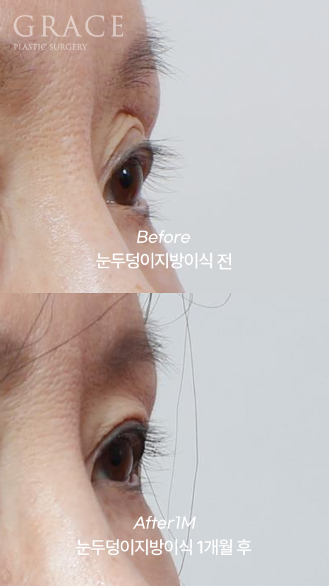 꺼진 아이홀 눈꺼풀 지방이식 (얇은 피부 부작용 붓기 등) 관련 이미지 5