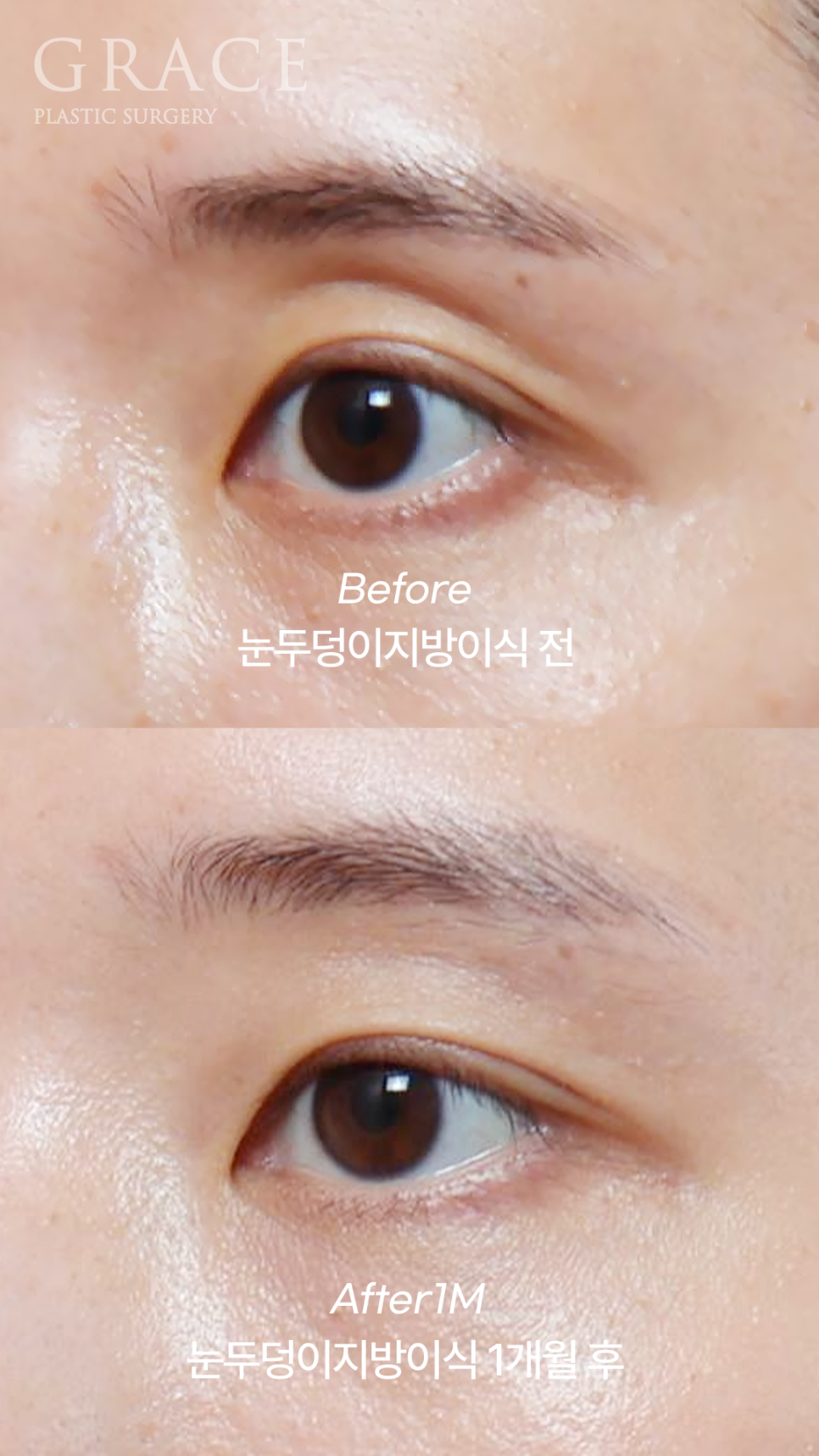 50대 눈꺼풀 지방이식 잘하는곳 염려되는 부작용 걱정까지 관련 이미지 4