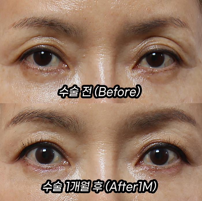 A Story About the Longevity of Eyelid (Eye Hole) Fat Grafting by Grace Plastic Surgery image 1