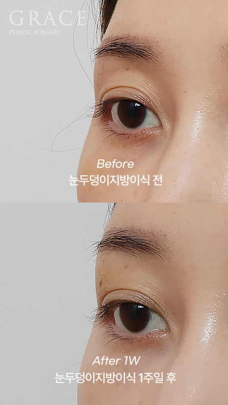 눈 감았을 때 울퉁불퉁? 실제 눈두덩이지방이식 전후 관련 이미지 6