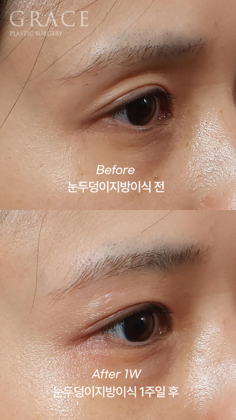 눈꺼풀 지방이식 눈 감았을 때 울퉁불퉁하지 않는 이유 전후사례로 보여드립니다 관련 이미지 1