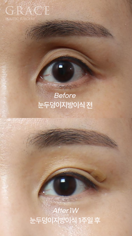 Why Injecting Fat Into the “Orbital Fat” Is Important in Sunken Eye Fat Grafting (dr.essay) image 9