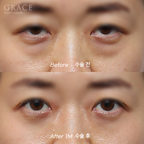Hollow Eye Holes + Under-Eye Puffiness → (Upper Eyelid Fat Grafting + Fat Repositioning) image 6