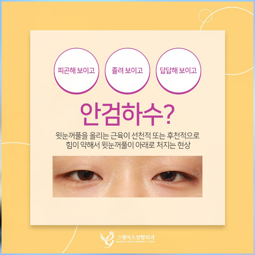 짝눈교정가격 내맘에 들도록 관련 이미지 6