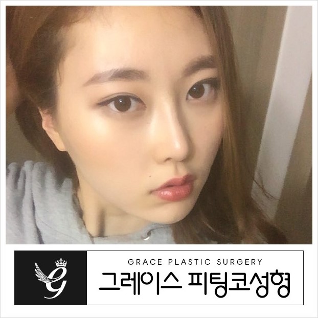 코성형잘하는 그레이스성형외과의 피팅코성형 관련 이미지 5