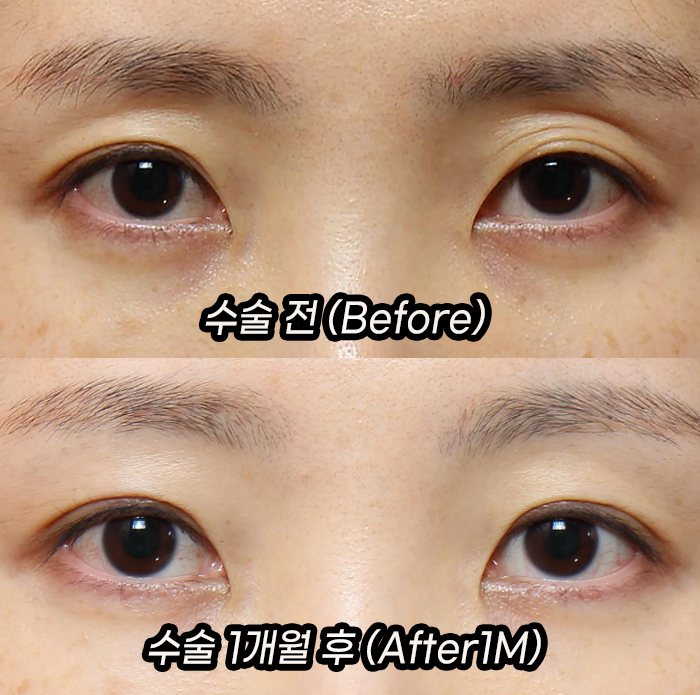 If Sunken Eyelids Are Left Untreated, About Hollows in the Eye-Hole Area (Fat Grafting) image 6