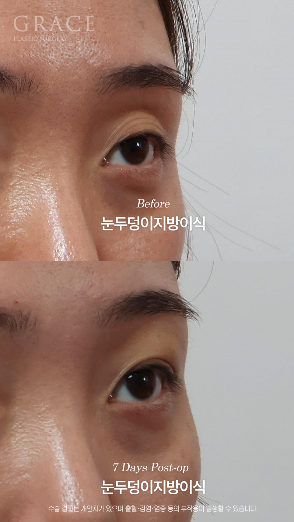 그레이스성형외과 눈두덩이 지방이식으로 채웠는데 눈이 더 잘 떠지는 이유 관련 이미지 8