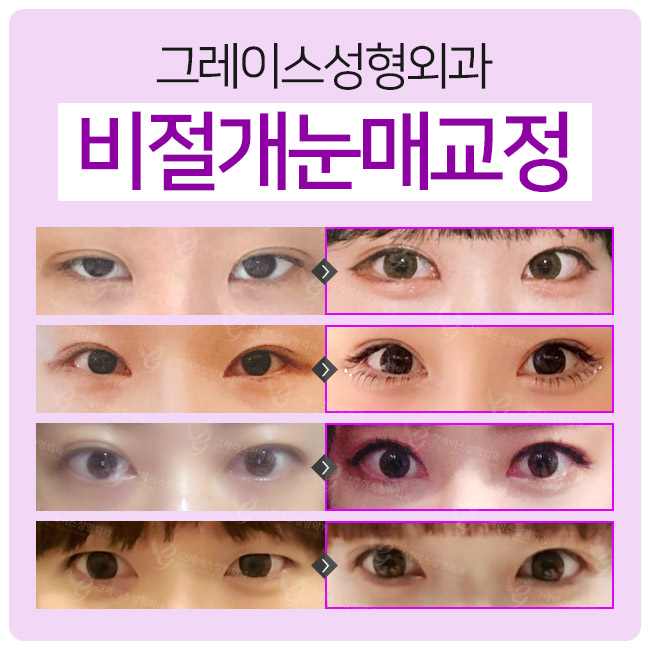 졸린 눈 탈출! 자연유착쌍꺼풀과 비절개눈매교정으로 관련 이미지 4