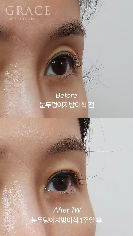 One-Week Changes After Eyelid Fat Grafting: Sunken Eye Hollows Regain Volume image 8