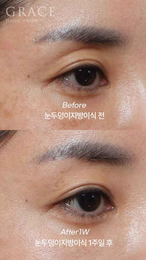 Week 1 After Upper Eyelid Fat Grafting in the Mid-40s: A Natural Return Without Swelling image 7