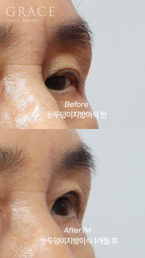 Will eyelid fat grafting be finished in one session? Progress after the first graft for a customer in their 60s and the planned second graft image 3