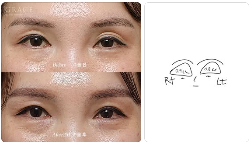 Complications from Sunken Eyelid Fat Grafting? The Injection Location Determines the Result image 8