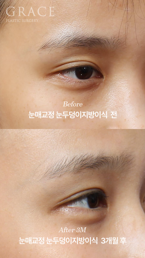 눈두덩이지방이식 붓기 언제 빠질까? 부작용&middot;유지기간까지 1주&middot;3개월&middot;6개월 변화 관련 이미지 8
