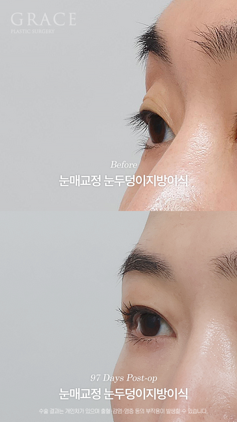 그레이스성형외과 눈두덩이 지방이식 1차로 끝내지 않은 진짜 이유 관련 이미지 7