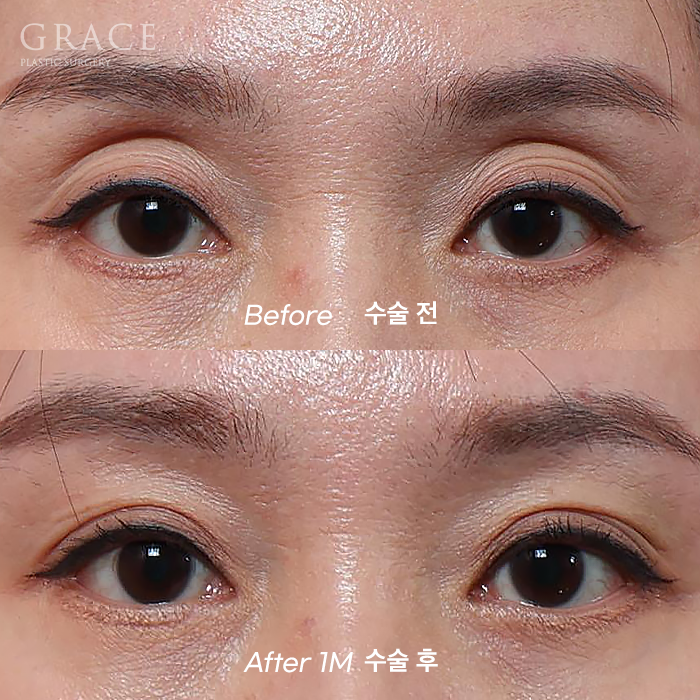 Upper Eyelid Fat Grafting Cost · Swelling, Reviews & Side Effects image 1