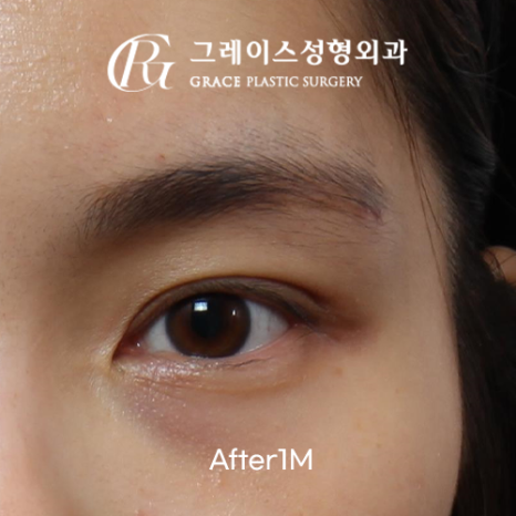 쌍꺼풀 짝짝이 아이홀 꺼짐까지&hellip; 부작용 걱정 없이 해결한 지방이식 관련 이미지 5