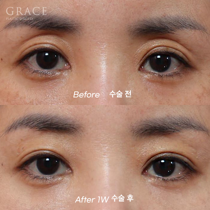 Understanding the Difference Between Forehead Fat Grafting (Eye Hollow Fat Grafting) and Fillers image 7