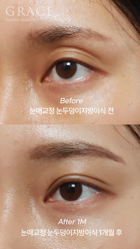 겹쌍꺼풀&middot;비대칭 눈 교정｜패인눈 함몰은 눈꺼풀 지방이식 관련 이미지 4