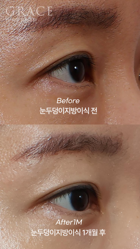 …The Result of Eyelid Fat Grafting (If You’re Worried About Side Effects and Swelling) image 6