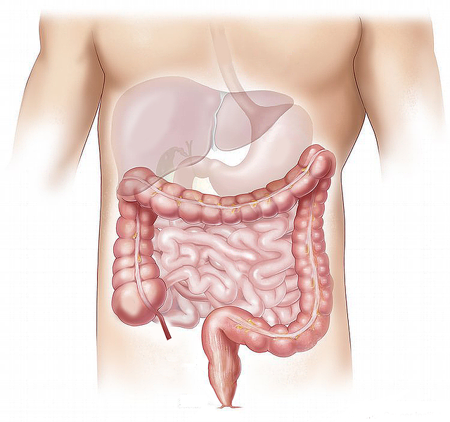 What Is Colorectal Cancer? What Are Its Main Causes? image 1