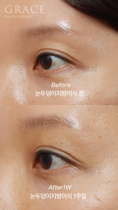 Fat Removal After Double Eyelid Surgery? Eyelid Fat Grafting After Double Eyelid Surgery Before & After image 5