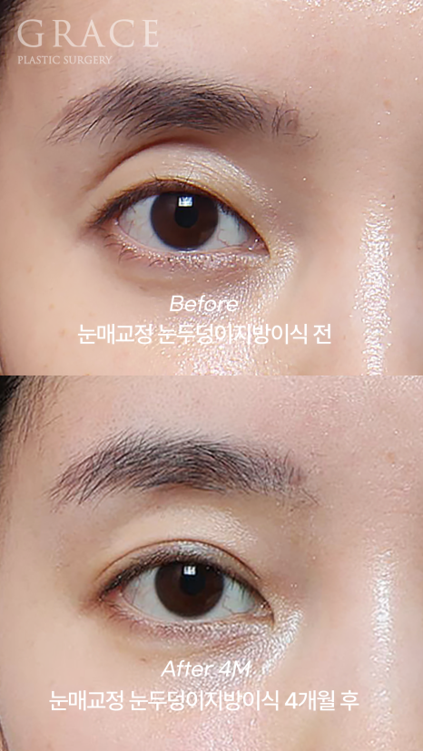 Review of 1cc Eyelid Fat Grafting for Sunken Upper Eyelids (Mid-30s, 4 Months Post-op Swelling and Scarring) image 3