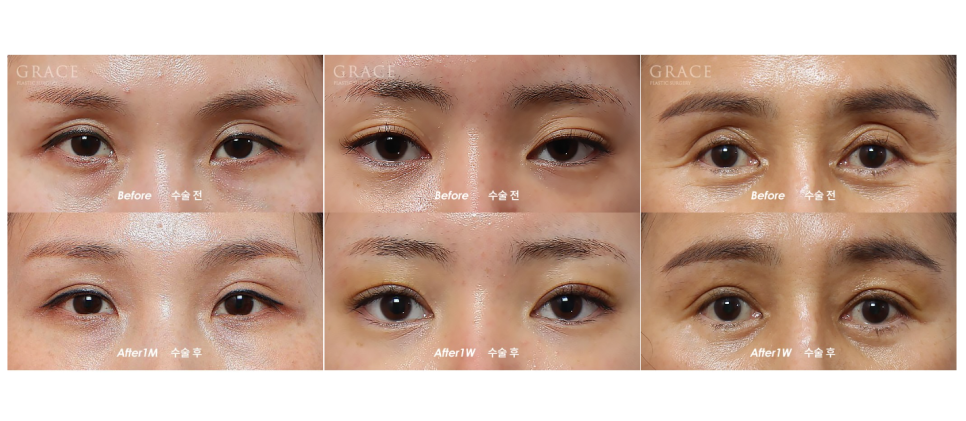If You’re Curious About Eyelid Fat Grafting Reviews, Costs, Prices, and Side Effects image 5