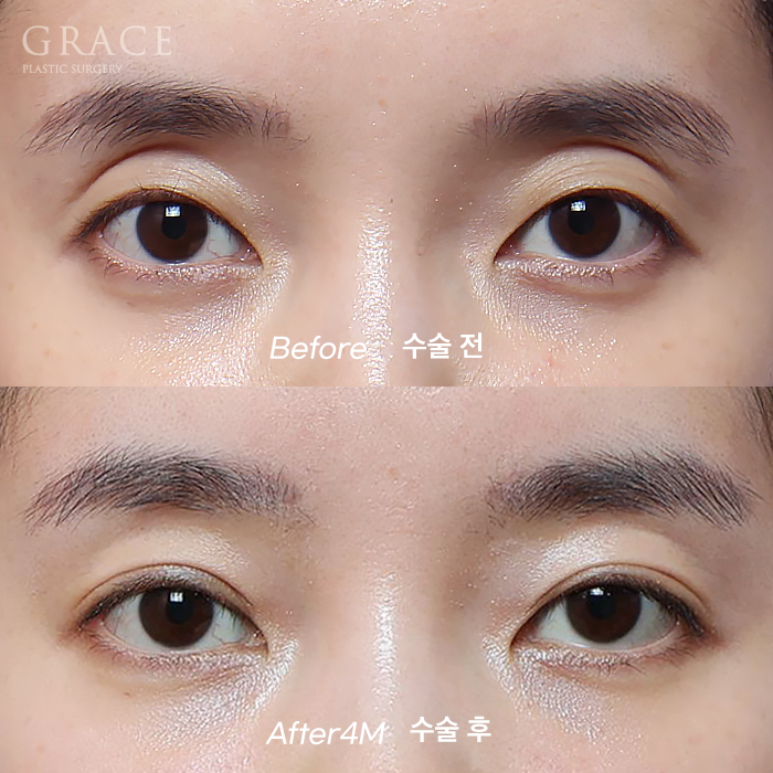 Review of 1cc Eyelid Fat Grafting for Sunken Upper Eyelids (Mid-30s, 4 Months Post-op Swelling and Scarring) image 1
