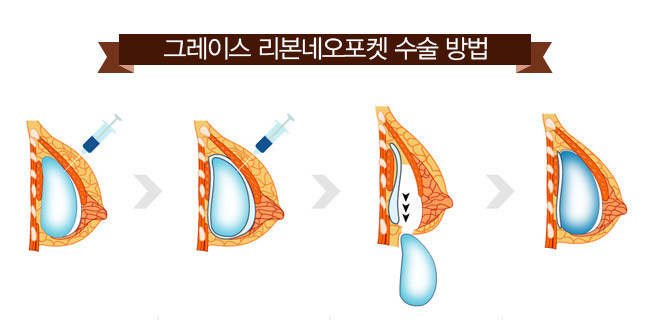 신사역 그레이스성형외과 리본유방재건(RE:BORN) 관련 이미지 3