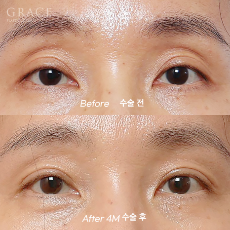 눈꺼풀지 방이식 심하게 꺼진 40대 눈 위 7일 만에 얼마나 달라졌을까? (그레이스성형외과 눈두덩이지방이식) 관련 이미지 2
