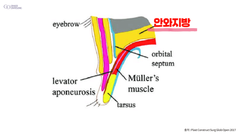 Revealing Why Fat Graft Is Placed into the Orbital Fat in the Upper Eyelid image 5