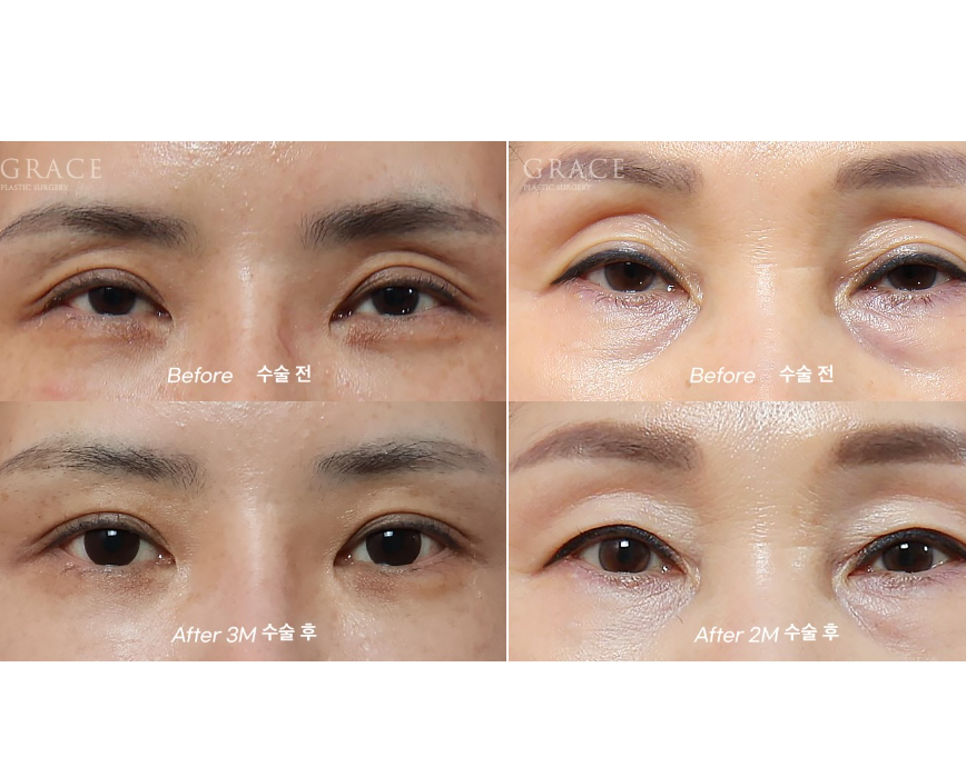 Grace Plastic Surgery Sunken Eye Hollows Upper Eyelid Fat Grafting image 2