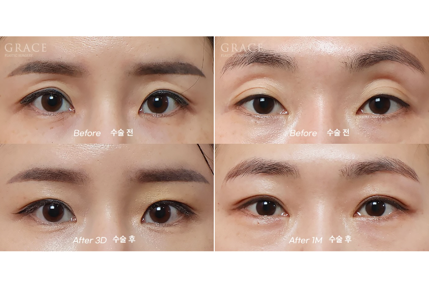 눈꺼풀 지방이식 후기처럼 자연스럽게 붓기&middot;흉터&middot;부작용 총정리 관련 이미지 3