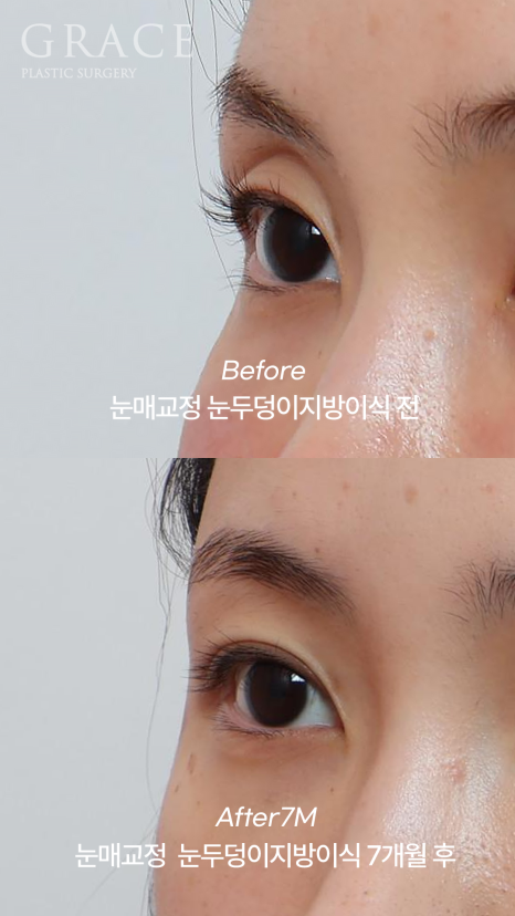 [20대 후반 눈꺼풀 지방이식+눈매교정]  7개월 후 유지력 이렇게 좋을 일? 관련 이미지 9