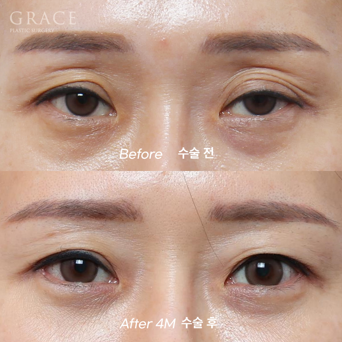 …The Result of Eyelid Fat Grafting (If You’re Worried About Side Effects and Swelling) image 7