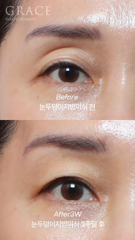 Celebrities with Sunken Eye Hollows, Filler Issue? Upper Eyelid Fat Grafting image 5